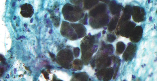 Melanin, a dark granular material in the center of image, in a pigmented melanoma (Nephron)