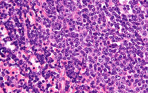 Chronic lymphocytic leukemia cells (University of California, San Diego)