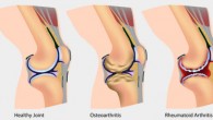 Rheumatoid arthritis is a chronic inflammatory disease that primarily affects the joints and surrounding tissue (Tulane University)