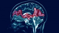 Epilepsy is a brain disorder causing seizures that disturb brain activity. Image credit: Epilepsy Foundation.
