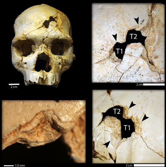 Frontal view of Cr-17 showing the position of the traumatic events and detailed views of the traumatic fractures. Image credit: Sala N et al.