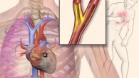 Illustration depicting angina. Image credit: Blausen Gallery 2014 / Wikiversity Journal of Medicine, doi: 10.15347/wjm/2014.010.