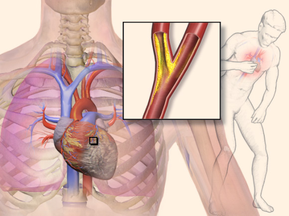 Illustration depicting angina. Image credit: Blausen Gallery 2014 / Wikiversity Journal of Medicine, doi: 10.15347/wjm/2014.010.