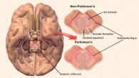 Parkinson’s disease. Image credit: Blausen Gallery 2014 / Wikiversity Journal of Medicine, doi: 10.15347/wjm/2014.010.