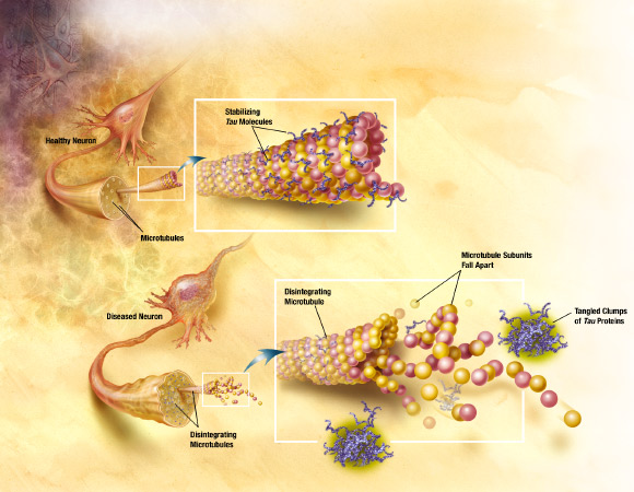 In AD, changes in tau protein lead to the disintegration of microtubules in brain cells. Image credit: Alzheimer’s Disease Education and Referral Center / National Institute on Aging.