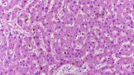 Liver showing accumulation of bilirubin pigment. Image credit: Department of Pathology, Calicut Medical College / CC BY-SA 4.0.