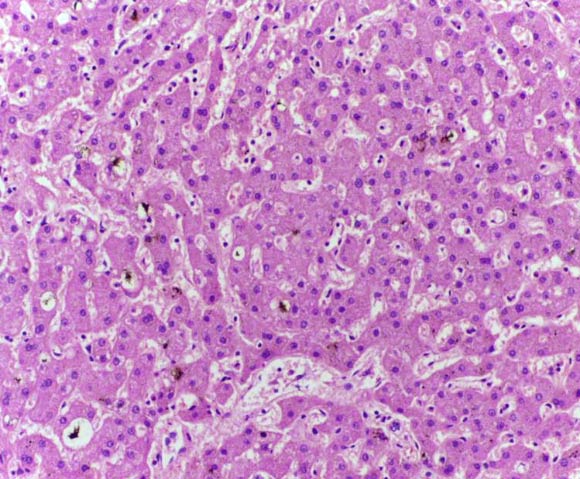 Liver showing accumulation of bilirubin pigment. Image credit: Department of Pathology, Calicut Medical College / CC BY-SA 4.0.