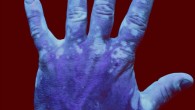UV photograph of a hand with vitiligo. Image credit: Chip Bobbert / CC BY-SA 4.0.