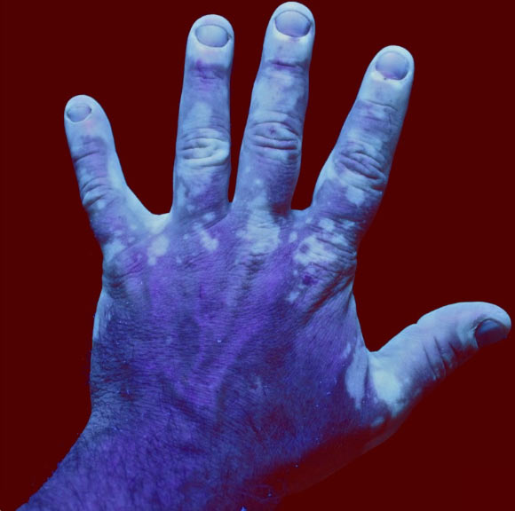 UV photograph of a hand with vitiligo. Image credit: Chip Bobbert / CC BY-SA 4.0.