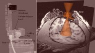 This image shows technology and methodology involved in MRI-guided transplantation of neural stem cells into the Parkinsonian brain. Image credit: Scott C. Vermilyea et al, doi: 10.3727/096368916X692979.