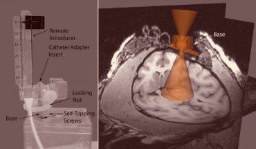 This image shows technology and methodology involved in MRI-guided transplantation of neural stem cells into the Parkinsonian brain. Image credit: Scott C. Vermilyea et al, doi: 10.3727/096368916X692979.