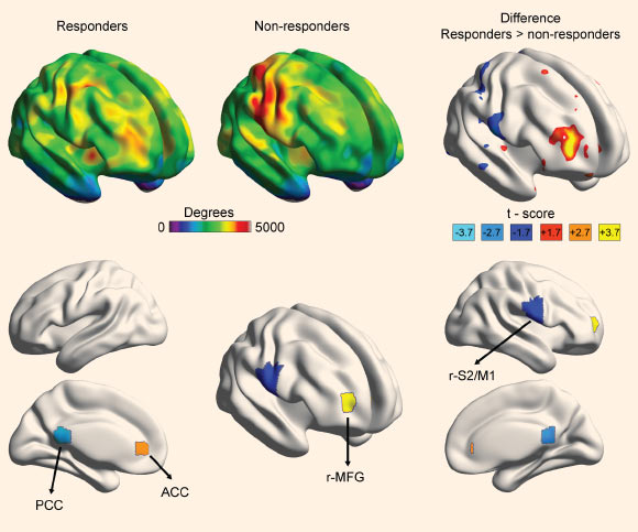 In the study, whole-brain degree count maps, collected before the start of treatment, were used to identify potential brain regional markers for placebo propensity. Group differences in whole-brain maps for degree count (number of connections of any location to the rest of the brain) between placebo responders and non-responders identified four brain regions that differentiated placebo responders from non-responders. The highest significant difference was seen for the right midfrontal gyrus. Abbreviations: r-MFG - right midfrontal gyrus; ACC - anterior cingulate cortex; PCC - posterior cingulate cortex; r-S2/M1 - right secondary somatosensory and primary motor cortex. Image credit: Tétreault P. et al.