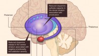 Cannabis use in humans is associated with reduced dopamine in the striatum. PET studies have shown lower striatal dopamine synthesis and release capacity in cannabis users. Lower dopamine synthesis capacity in the dorsal striatum is directly associated with reduced motivation levels, whereas reduced dopamine release in the ventral striatum is directly associated with negative emotion levels and severity of addiction. Image credit: Michael A. P. Bloomfield et al, doi: 10.1038/nature20153.