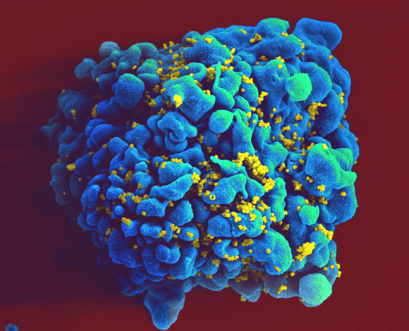 Scanning electromicrograph of an HIV-infected H9 T cell. Image credit: NIAID / CC BY 2.0.