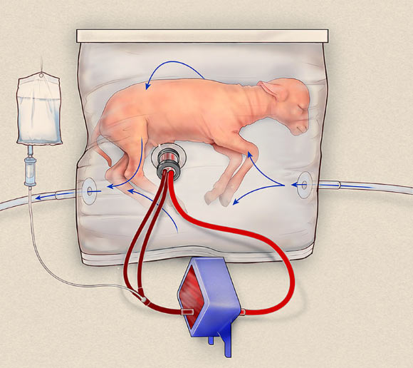 Most previous attempts at creating a womb-like device used artificial pumps to drive the blood through the system, causing heart failure. In the system invented by Partridge et al, the fetal heart is the only pump. It is different in other key ways. Use of the bag, rather than a more open container, nearly eliminated the infection issues that contributed to previous failures. And while previous attempts relied on blood vessels in the neck, the authors figured out how to quickly and successfully insert tubes (cannulas) into the notoriously touchy umbilical vessels. Image credit: Children’s Hospital of Philadelphia.