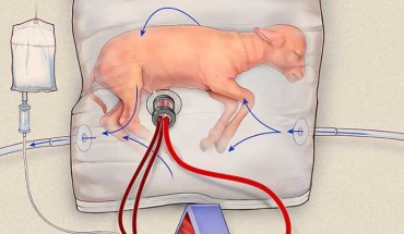 Most previous attempts at creating a womb-like device used artificial pumps to drive the blood through the system, causing heart failure. In the system invented by Partridge et al, the fetal heart is the only pump. It is different in other key ways. Use of the bag, rather than a more open container, nearly eliminated the infection issues that contributed to previous failures. And while previous attempts relied on blood vessels in the neck, the authors figured out how to quickly and successfully insert tubes (cannulas) into the notoriously touchy umbilical vessels. Image credit: Children’s Hospital of Philadelphia.