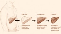 Stages of liver disease. Image credit: National Institute of Diabetes and Digestive and Kidney Diseases.