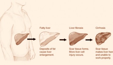 Stages of liver disease. Image credit: National Institute of Diabetes and Digestive and Kidney Diseases.