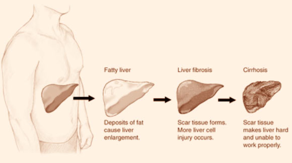 Stages of liver disease. Image credit: National Institute of Diabetes and Digestive and Kidney Diseases.