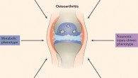 Phenotypes of osteoarthritis: evidence suggests that patients with osteoarthritis fall into multiple phenotypic subgroups defined on the basis of the main driver of disease, one of which is a distinct metabolic phenotype, although all osteoarthritis phenotypes probably involve metabolic alterations; cartilage, bone and synovium are all affected by external and internal drivers of disease such as inflammation, injury or biomechanical alterations, metabolic reprogramming and immunomodulation, but different synovial joint tissues dominate the disease in different patients with osteoarthritis. Image credit: Mobasheri et al / Nature Reviews Rheumatology, doi: 10.1038/nrrheum.2017.50.