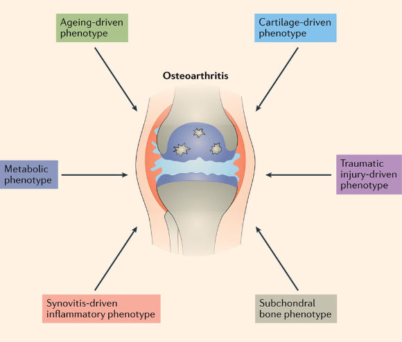 Phenotypes of osteoarthritis: evidence suggests that patients with osteoarthritis fall into multiple phenotypic subgroups defined on the basis of the main driver of disease, one of which is a distinct metabolic phenotype, although all osteoarthritis phenotypes probably involve metabolic alterations; cartilage, bone and synovium are all affected by external and internal drivers of disease such as inflammation, injury or biomechanical alterations, metabolic reprogramming and immunomodulation, but different synovial joint tissues dominate the disease in different patients with osteoarthritis. Image credit: Mobasheri et al / Nature Reviews Rheumatology, doi: 10.1038/nrrheum.2017.50.