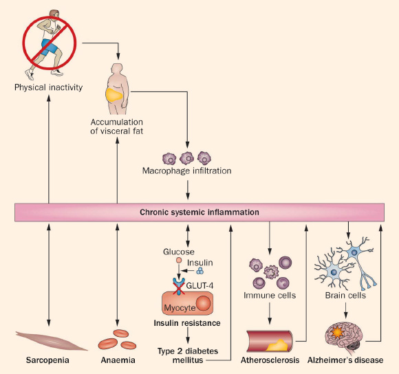 Chronic systemic inflammation predisposes to insulin resistance, dyslipidaemia, endothelial dysfunction, accelerated atherosclerosis, neurodegeneration, anemia and muscle waste, which may contribute to disability and decreased physical activity. Lack of physical activity will provoke accumulation of visceral fat and thereby further enhance inflammation and the onset of metabolic disorders, atherosclerosis and the development of a network of chronic diseases. A vicious circle of chronic inflammation in inflammatory rheumatic diseases, in which the state of chronic inflammation is accompanied by anemia, tiredness and muscle waste which together with other comorbidities and the disease-specific symptoms will lead to further deconditioning and a worsening of the chronic inflammation, which again will negatively affect cardiovascular performance and physical activity in a positive feedback loop. Image credit: Bente Klarlund Pedersen, doi: 10.1111/eci.12781.