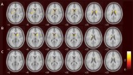 ANCOVA (analysis of covariance) comparing decline in DaTscan (electrocardiographic and single photon emission CT) binding between the placebo and exenatide groups: (A) placebo group: reduced DaTscan binding in the left caudate, right caudate, and left putamen; (B) exenatide group: reduced DaTscan binding in the left caudate and right caudate; (C) significant clusters derived from the first level of analysis used to do an ANCOVA between placebo and exenatide groups showing a reduced rate of decline in the right caudate, left putamen, and right putamen. Image credit: Athauda et al, doi: 10.1016/S0140-6736(17)31585-4.