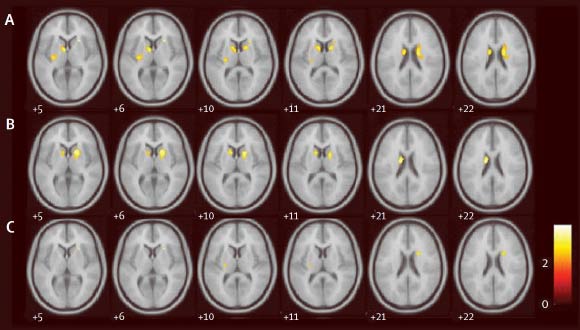 ANCOVA (analysis of covariance) comparing decline in DaTscan (electrocardiographic and single photon emission CT) binding between the placebo and exenatide groups: (A) placebo group: reduced DaTscan binding in the left caudate, right caudate, and left putamen; (B) exenatide group: reduced DaTscan binding in the left caudate and right caudate; (C) significant clusters derived from the first level of analysis used to do an ANCOVA between placebo and exenatide groups showing a reduced rate of decline in the right caudate, left putamen, and right putamen. Image credit: Athauda et al, doi: 10.1016/S0140-6736(17)31585-4.