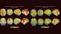 3D surface and midsagittal images illustrating regional sex differences in rCBF (regional cerebral blood flow). Image credit: Daniel G. Amen et al, doi: 10.3233/JAD-170432.
