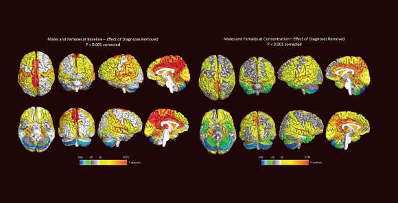 3D surface and midsagittal images illustrating regional sex differences in rCBF (regional cerebral blood flow). Image credit: Daniel G. Amen et al, doi: 10.3233/JAD-170432.