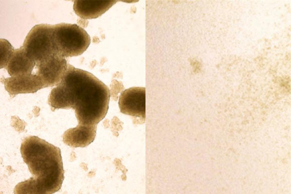 Brain cancer stem cells (left) are killed by Zika virus infection (image at right shows cells after Zika treatment). Image credit: Zhe Zhu.