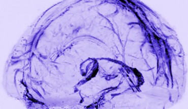 Brain scans of healthy volunteers showed that human brains may drain waste through lymphatic vessels. Image credit: Reich Lab, NIH / NINDS.