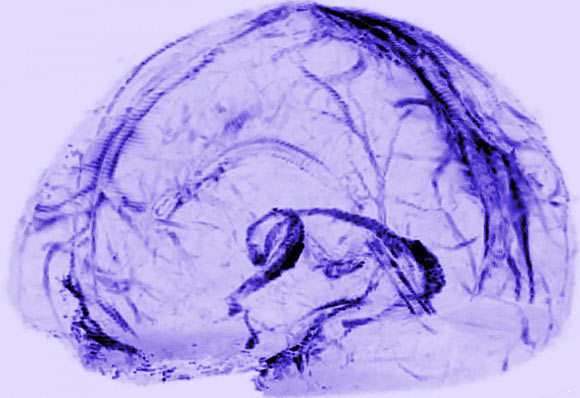 Brain scans of healthy volunteers showed that human brains may drain waste through lymphatic vessels. Image credit: Reich Lab, NIH / NINDS.