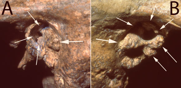 Two views of the ear canal of the Neanderthal fossil Shanidar 1 show substantial deformities that would likely have caused profound deafness. Image credit: Erik Trinkaus.