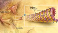 Alzheimer’s disease is a progressive neurodegenerative disease, characterized clinically by progressive memory loss, cognitive decline, and aberrant behavior. In Alzheimer’s, changes in tau protein lead to the disintegration of microtubules in brain cells. Image credit: Alzheimer’s Disease Education and Referral Center / National Institute on Aging.