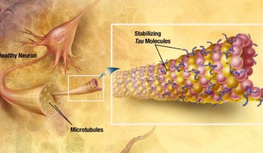 Alzheimer’s disease is a progressive neurodegenerative disease, characterized clinically by progressive memory loss, cognitive decline, and aberrant behavior. In Alzheimer’s, changes in tau protein lead to the disintegration of microtubules in brain cells. Image credit: Alzheimer’s Disease Education and Referral Center / National Institute on Aging.