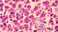 This is the first study to report the detection of DNA of Mycobacterium avium ssp. paratuberculosis in the blood of rheumatoid arthritis patients. Image credit: Edwin P. Ewing, Jr. / CDC.