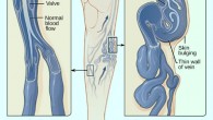 Chang et al found a significant association between varicose veins and DVT. The illustration shows how a varicose vein forms in a leg. Image credit: National Heart Lung and Blood Institute / Jmarchn / CC BY-SA 3.0.