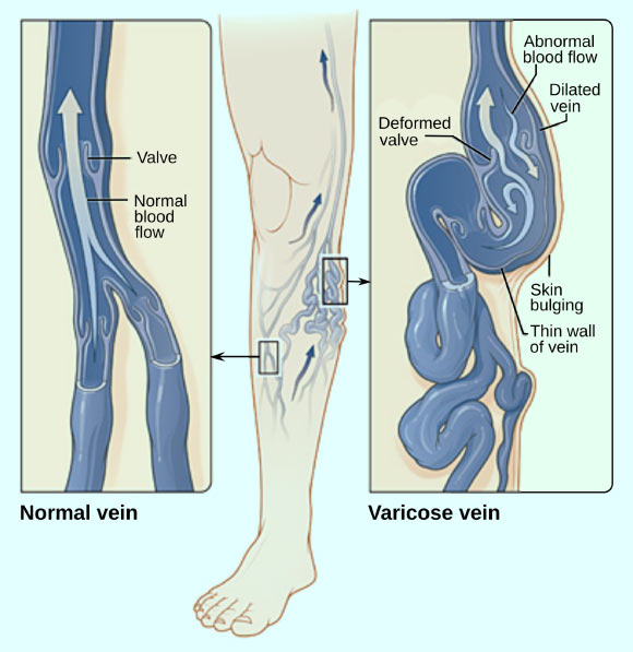 Chang et al found a significant association between varicose veins and DVT. The illustration shows how a varicose vein forms in a leg. Image credit: National Heart Lung and Blood Institute / Jmarchn / CC BY-SA 3.0.