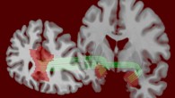 According to Jung et al, risk tolerance was positively associated with functional connectivity between amygdala and medial prefrontal cortex and negatively associated with structural connectivity between these regions. Image credit: University of Pennsylvania.