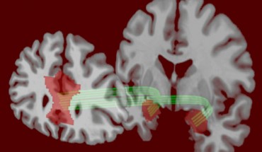 According to Jung et al, risk tolerance was positively associated with functional connectivity between amygdala and medial prefrontal cortex and negatively associated with structural connectivity between these regions. Image credit: University of Pennsylvania.