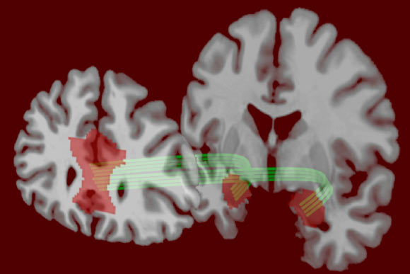 According to Jung et al, risk tolerance was positively associated with functional connectivity between amygdala and medial prefrontal cortex and negatively associated with structural connectivity between these regions. Image credit: University of Pennsylvania.