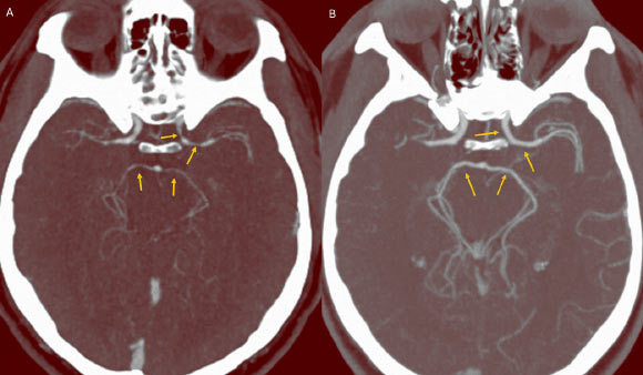 (A) CT angiography showing unexpected luminal narrowing in the left supraclinoid internal carotid artery, M1 segment of bilateral middle cerebral arteries, and P1 segments of bilateral posterior cerebral arteries consistent with vasospasm; (B) CT angiography showing resolution of luminal narrowing after 5 weeks of supportive care. Image credit: Boddhula et al, doi: 10.1136/bcr-2017-224085.