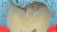Dogan et al developed a way to cure dental cavities. Image credit: University of Washington.