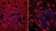 Left: this image shows fibrotic heart cells from a patient who had heart failure; the cells have an elaborate fibronectin matrix (shown in red) which causes fibrosis and heart damage. Right: in this image, human heart cells treated with the novel therapeutic peptide exhibit dramatically reduced fibrosis; the experimental treatment prevented the human heart cells from failing and restored their function. Image credit: Cincinnati Children’s Heart Institute.