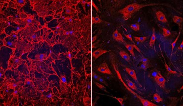 Left: this image shows fibrotic heart cells from a patient who had heart failure; the cells have an elaborate fibronectin matrix (shown in red) which causes fibrosis and heart damage. Right: in this image, human heart cells treated with the novel therapeutic peptide exhibit dramatically reduced fibrosis; the experimental treatment prevented the human heart cells from failing and restored their function. Image credit: Cincinnati Children’s Heart Institute.