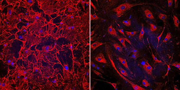 Left: this image shows fibrotic heart cells from a patient who had heart failure; the cells have an elaborate fibronectin matrix (shown in red) which causes fibrosis and heart damage. Right: in this image, human heart cells treated with the novel therapeutic peptide exhibit dramatically reduced fibrosis; the experimental treatment prevented the human heart cells from failing and restored their function. Image credit: Cincinnati Children’s Heart Institute.