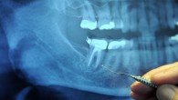 Opioid medication and medication combinations are not among the most effective or long lasting of the options available for relief of acute dental pain. Image credit: Wonderlane / Alan Carr / CC BY 2.0.