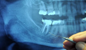 Opioid medication and medication combinations are not among the most effective or long lasting of the options available for relief of acute dental pain. Image credit: Wonderlane / Alan Carr / CC BY 2.0.