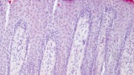 Lesional psoriatic skin. Image credit: Wu et al, doi: 10.1371/journal.pone.0005227.